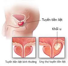 Ung thư tuyến tiền liệt